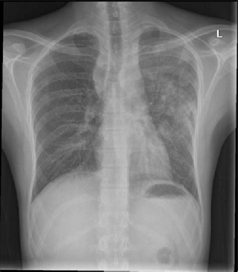 Figure 1 from Tuberculous paraspinal abscess: a case of mistaken identity | Semantic Scholar