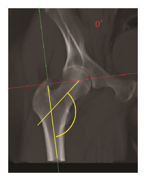 Effect Of Hip Rotation On The Projected Neck Shaft Angle Nsa The Download Scientific Diagram