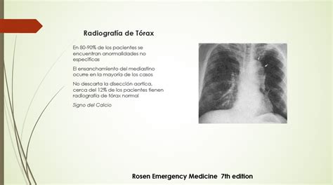 Emergencias Médicas Aneurisma Disecante de Aorta Gastro Mérida