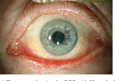 Figure 1 From Alternative Treatment Options For Periocular Basal Cell Carcinoma A Narrative