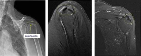 Boston Shoulder Institute Calcific Tendinitis Images 2