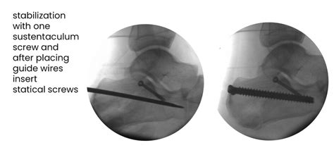 calcaneal fracture, both sides tongue - Minimal invasive treatment of ...