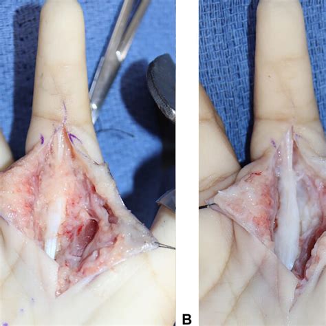 A Infiltrative Mass Involving The A2 Pulley Before Debridement And B