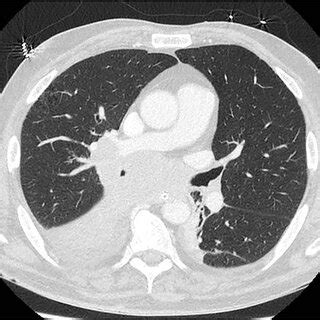 CT Of The Chest From Day Two Admission Demonstrating Soft Tissue Mass