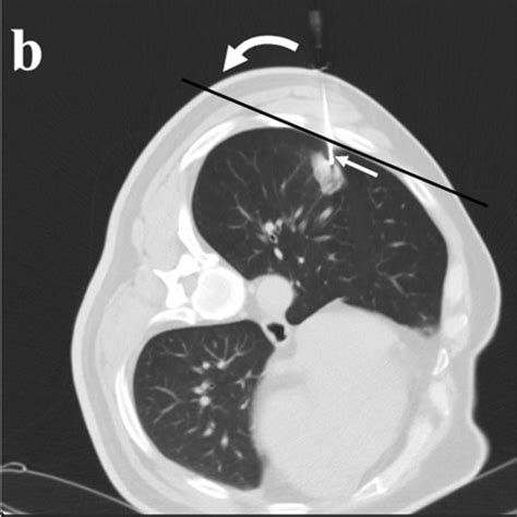 A Ct Guided Core Needle Biopsy Of A Solitary Suspected Lesion In The Download Scientific