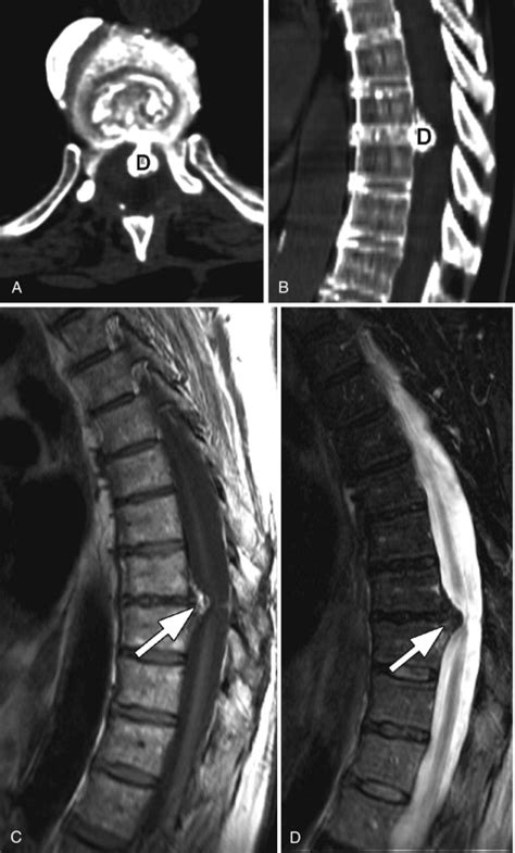 Ossification Of The Posterior Longitudinal Ligament Radiology Key