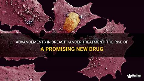 Advancements In Breast Cancer Treatment The Rise Of A Promising New Drug Medshun