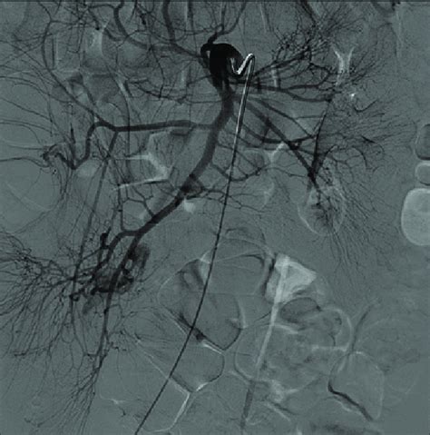 Contrast Medium Injection After Selective Catheterization Of The Sma Download Scientific