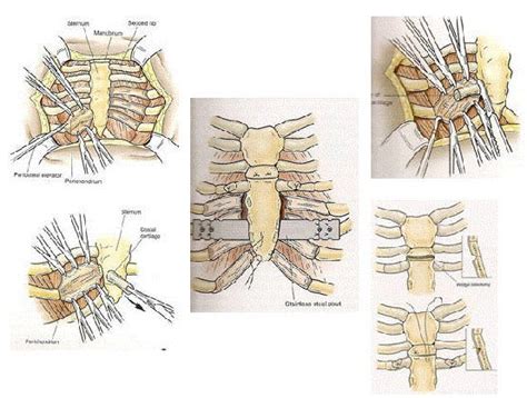 pectus carinatum surgery. Find out whether any of your family… | by ...