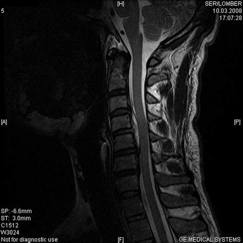 A Patient With Brucellar Cervical Spondylodiscitis Complicated By