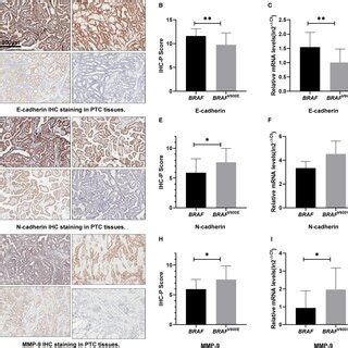 Brafv E Mutationinduced Emt In Ptc Patients A D And G Typical