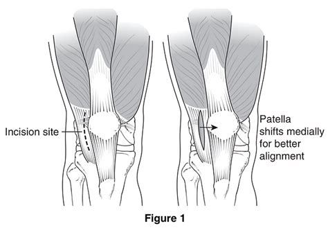 Patella Dislocation & Sublux Surgery | Lower Limb Surgery