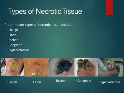 Protocols Of Wound Debridement Ppt