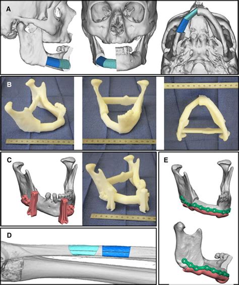 3D Printing In Reconstruction Planning Digital Rendering And