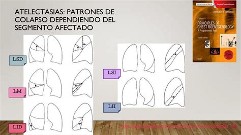 Signos Radiograficos En El Torax Del Adulto PPT