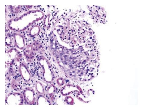 Light Microscopy Showing Diffuse Cellular Crescent Formation