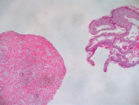 Figure 1 From A Case Of Aplasia Cutis Congenita Type VI Bart Syndrome