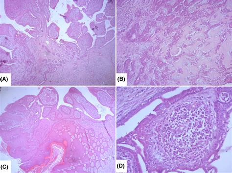 A Verrucous Tumor Of The Leg Atypical Case Of Syringocystadenoma