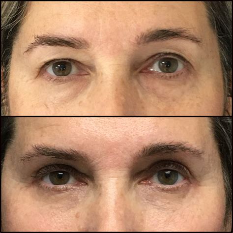 Upper Lower Blepharoplasty With Fat Transfer Before After Photos