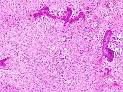 Ossifying Fibroma Tibia