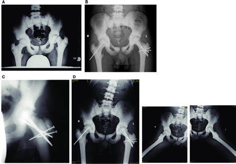 Subcapital Realignment Of A Severe Chronic Slipped Capital Femoral