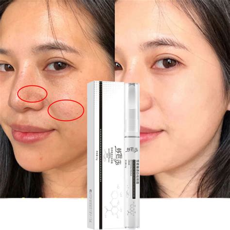 Nicotinamide Dark Spot Corrector Cream Whitening Freckle Cream Powerful