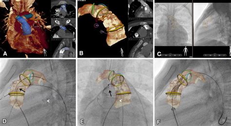 Vesselnavigator Assisted Percutaneous Pulmonary Valve Implantation In