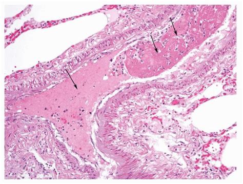 Pulmonary Embolism And Infarction Thoracic Key