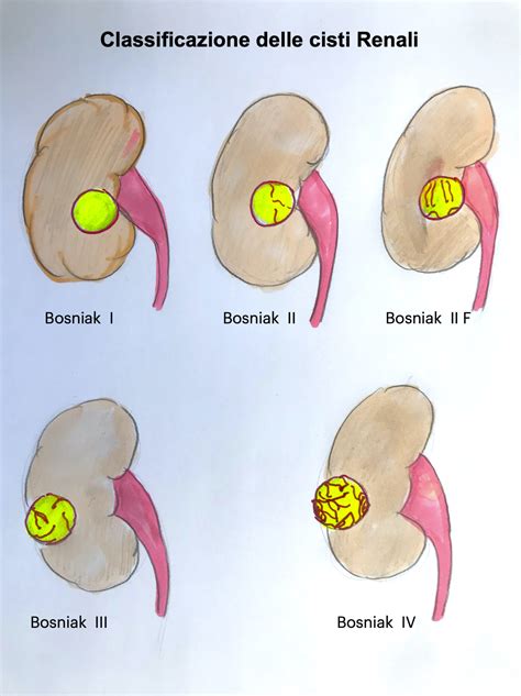 Malattia Renale Multiloculare A Cisti