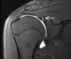 Mri Shoulder Labrum Tear