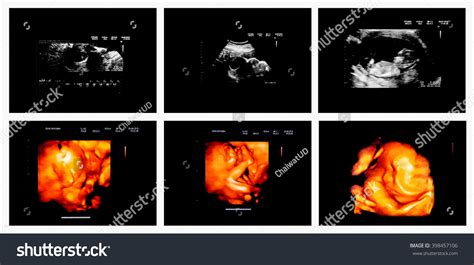 Collection Set Ultrasound Image Baby Womb Stock Photo 398457106 ...