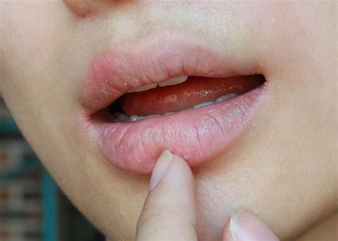 Hiv Mouth Sores Pictures Causes Treatment And Off