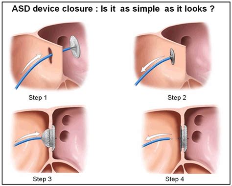 Critical Issues In ASD Device Closure Dr S Venkatesan MD