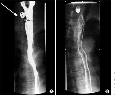 Figure 3 From A Case Of Zenker’s Diverticulum Mimicking A Right Side Thyroid Nodule Semantic