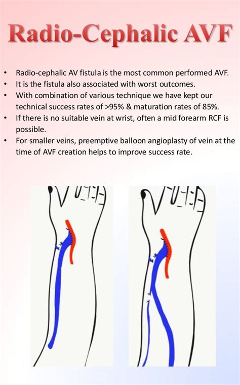 Arteriovenous Fistula