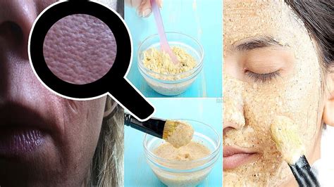 How To Get Rid Of Large Open Pores Permanently Top 5 Ways To Get Rid Of Large Pores Youtube