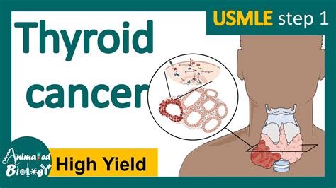 Thyroid Cancer Papillary Follicular Medullary Anaplastic