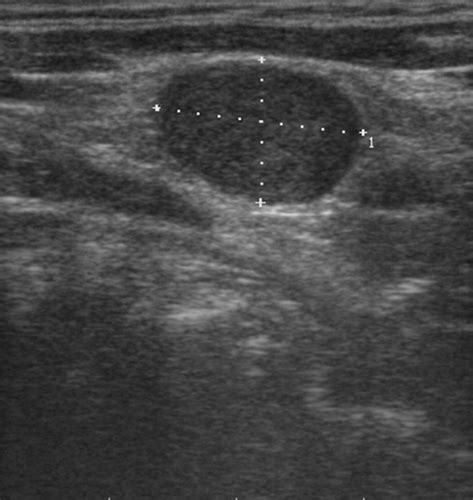 Lymph Node Cancer Ultrasound - Vrogue.co