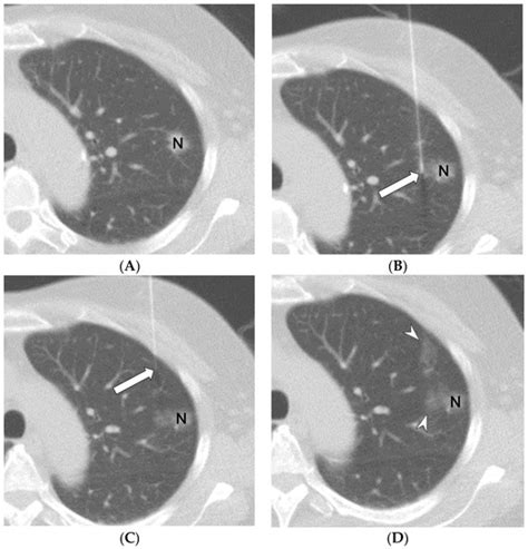 Diagnostics Free Full Text Complications During Ct Guided Lung