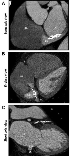 Percutaneous Atriotomy For Levoatrialtocoronary Sinus Shunting In