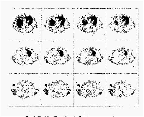 Figure 2 From Computer Aided Diagnosis CAD Of Breast Mass On