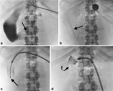 Percutaneous Removal Of Migrated Gastrointestinal Stents Using