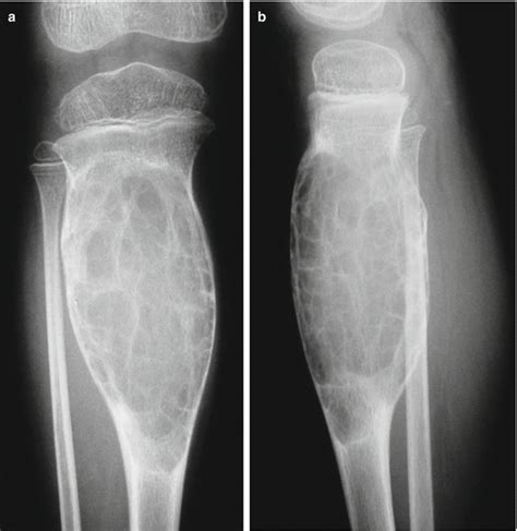 Aneurysmal Bone Cyst Musculoskeletal Key