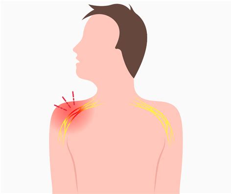 Brachial Plexus
