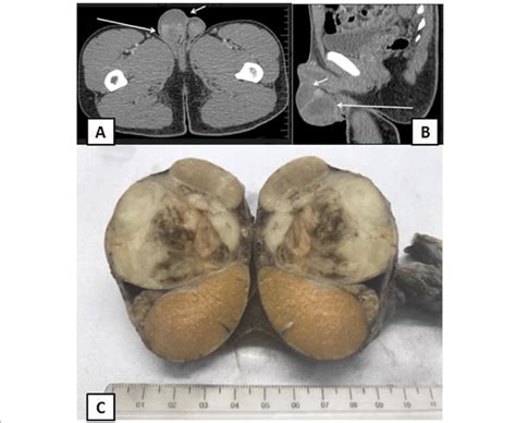 Imaging And Gross Findings A Computer Tomography Axial View Long