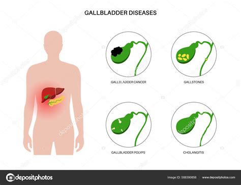 Gallbladder Diseases Infographic Gallstone Cancer Acute Cholecystitis