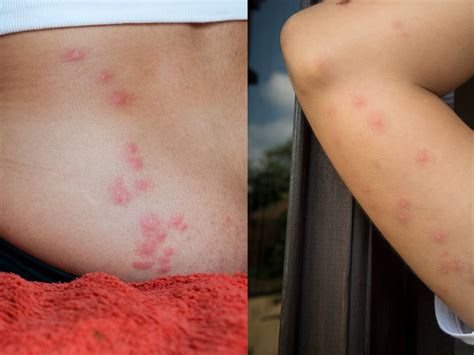 Bed Bug Bites Pictures Symptoms What Do Bed Bug Bites Look Like Ph