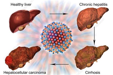 Stages of liver disease in hepatitis C, illustration - Stock Image F019/6452 - Science Photo Library