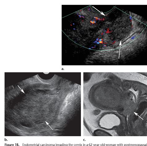 Figure 3 From Us Of The Nongravid Cervix With Multimodality Imaging Correlation Normal