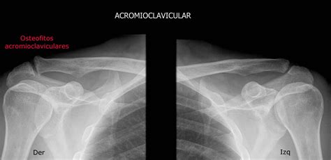 Artrosis Acromio Clavicular Guido Fierro